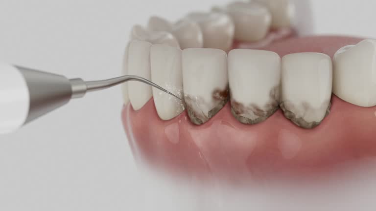 Reliable Tooth Extraction contractor in Wellsville, UT by Smile Center Dentistry